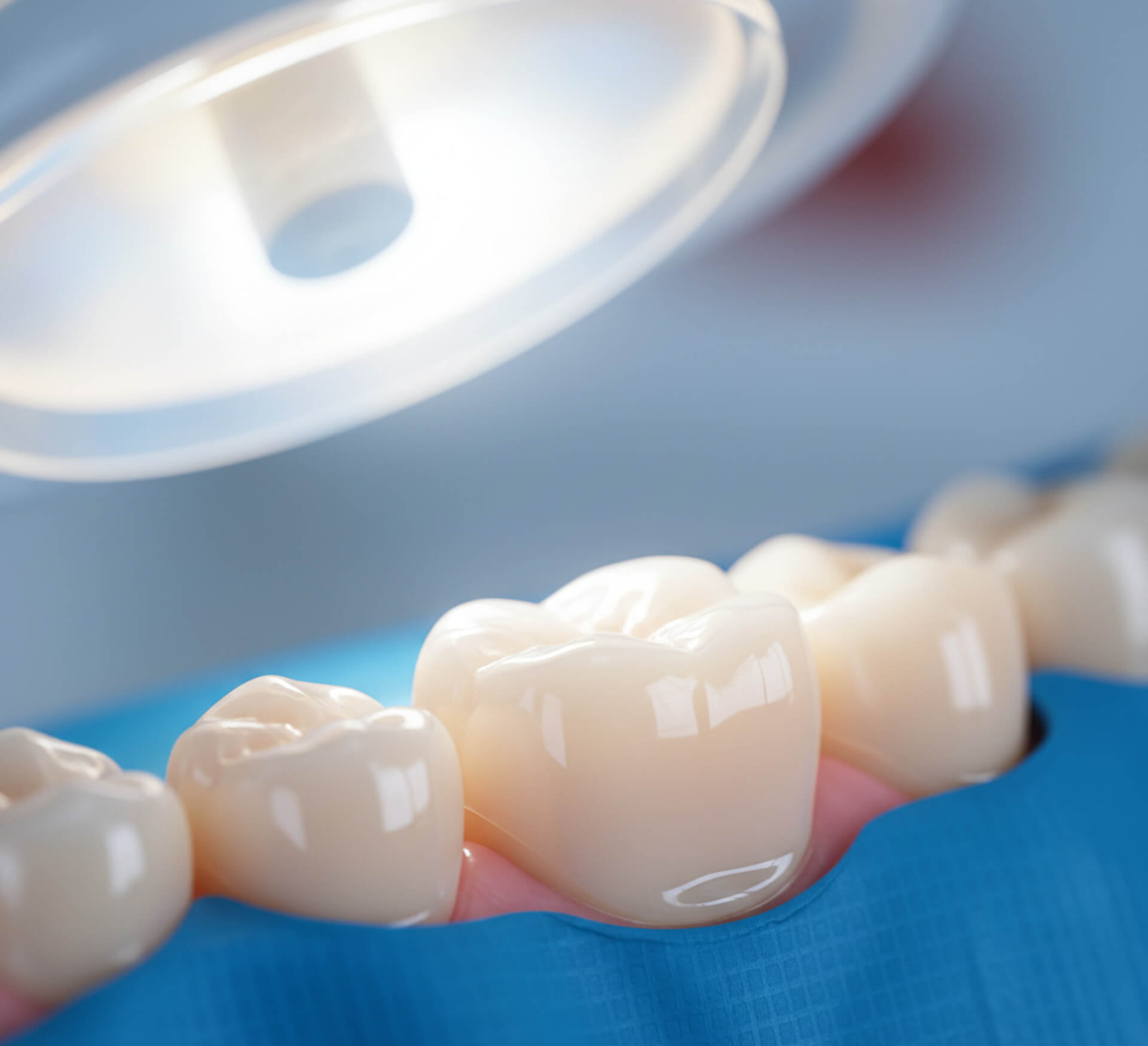 Dental sealants applied on molars under dental light, showcasing preventive care for children and families.