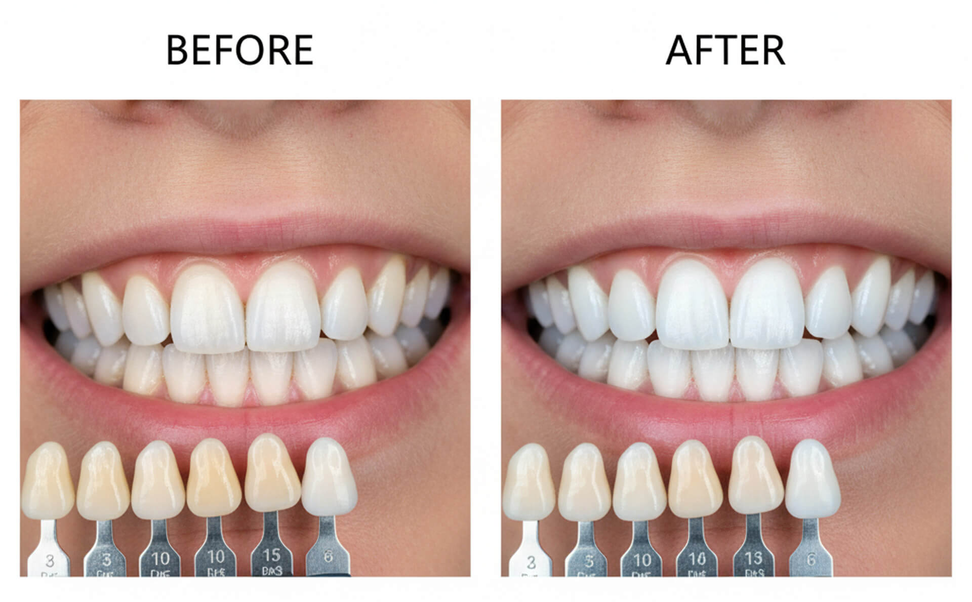 Before and after comparison of teeth whitening results, showcasing significant brightness improvement, with dental shade guide displaying color change from yellowish to bright white teeth.