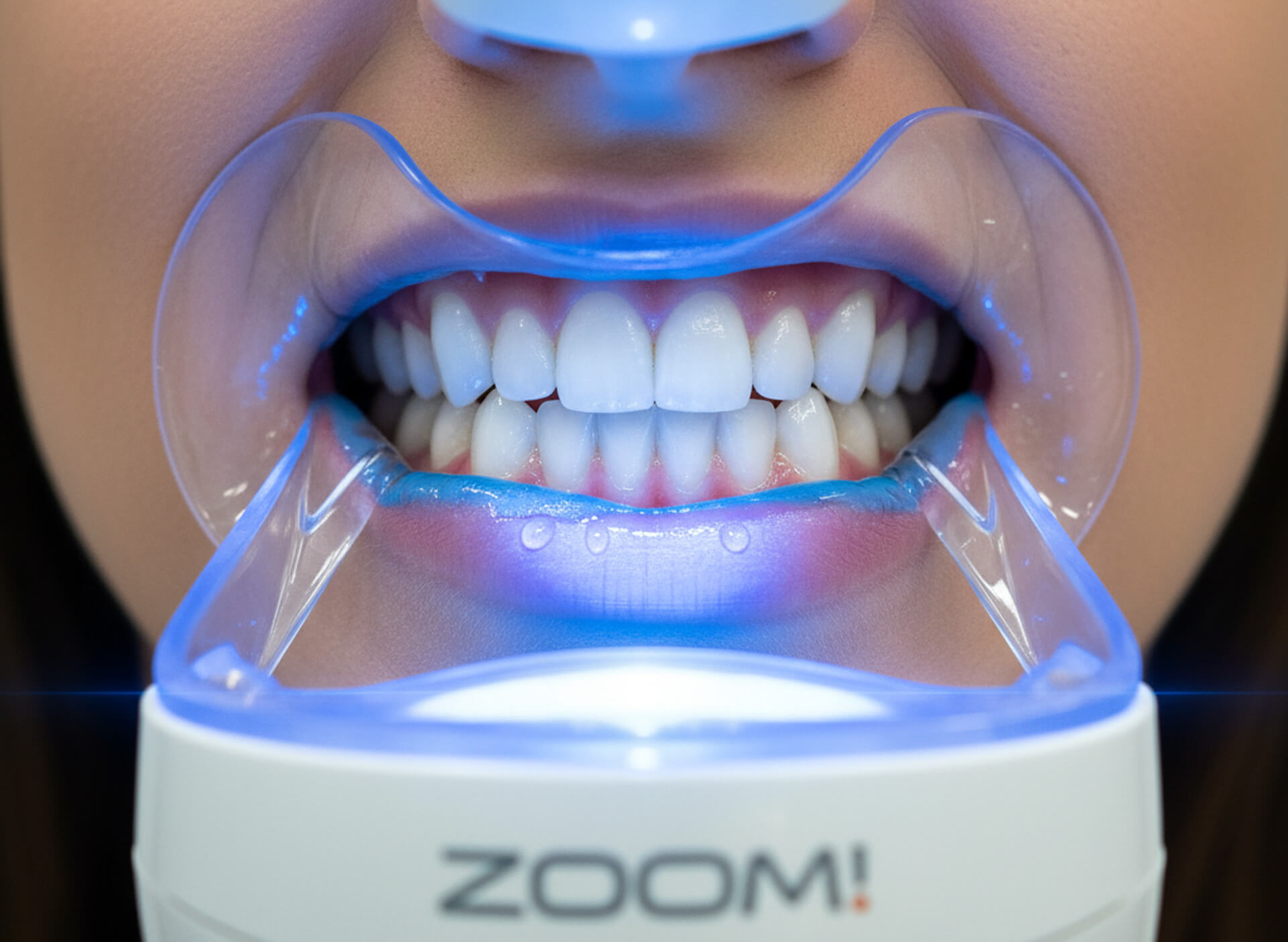 Close-up of a patient's bright white teeth during ZOOM! Whitening treatment, featuring a dental mouthpiece and LED light for effective teeth whitening in a professional dental setting.