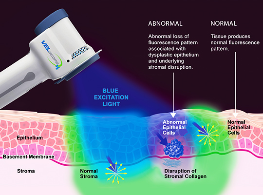 VELscope oral cancer screening device emitting blue excitation light, illustrating normal and abnormal fluorescence patterns in oral tissue, highlighting detection of epithelial abnormalities and stroma disruption.